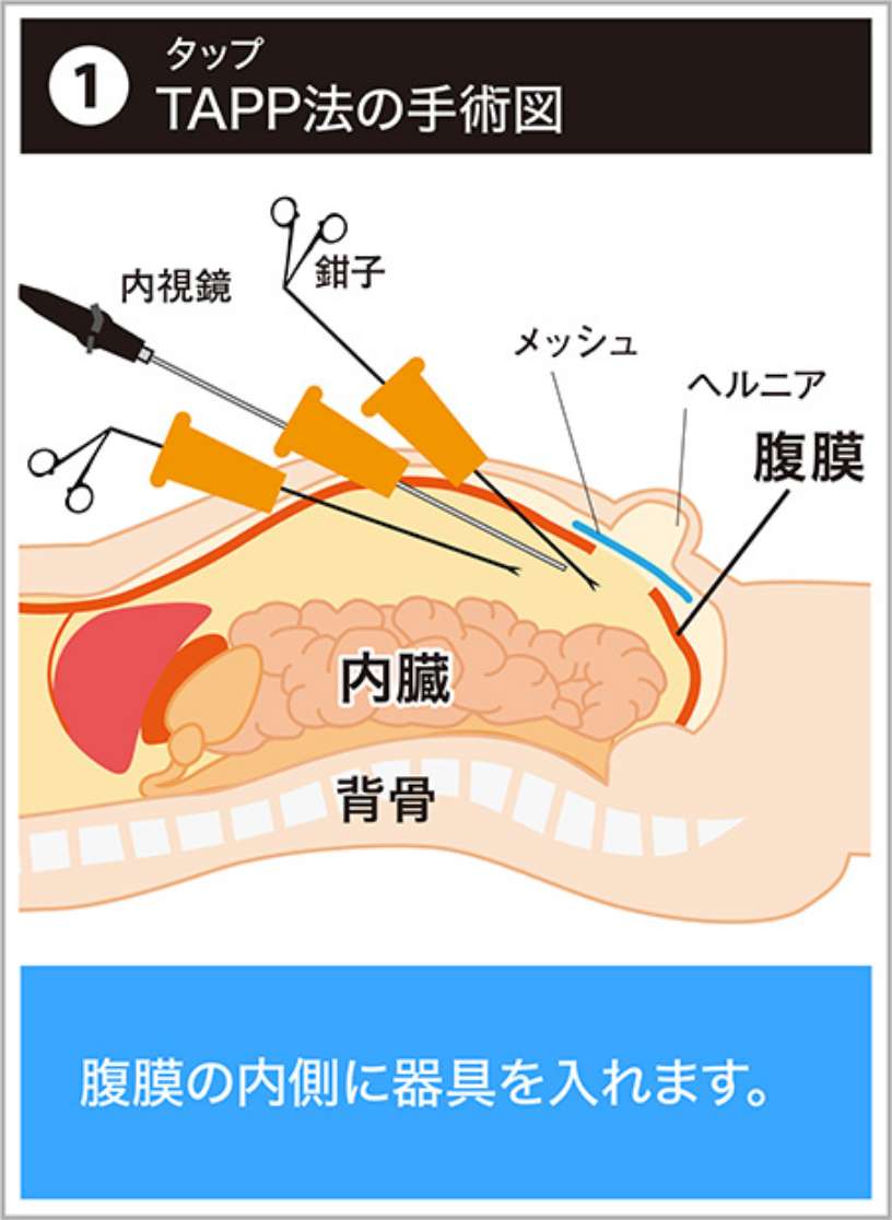 TAPP法の手術図 腹膜の内側に器具を入れます。
