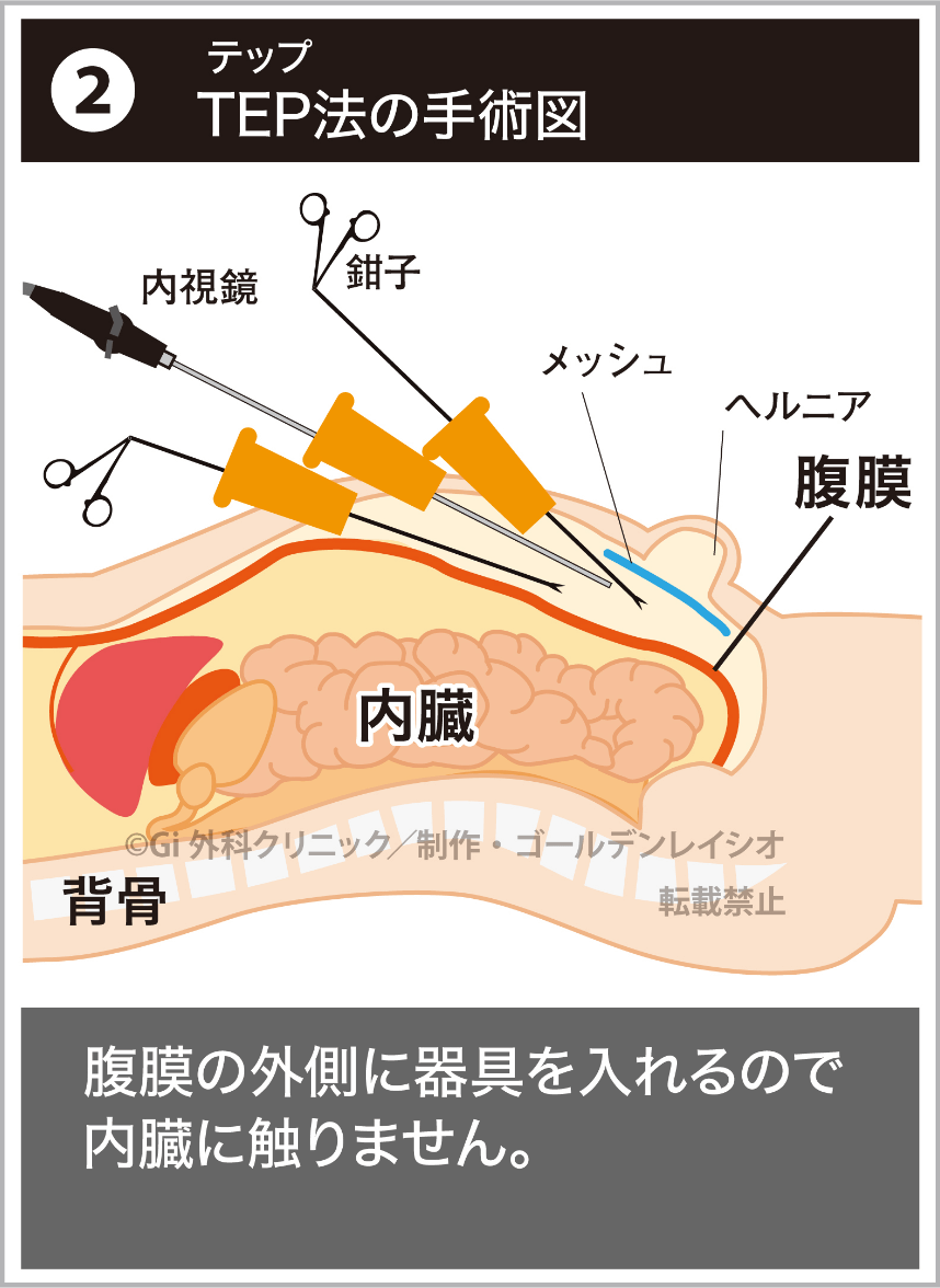 ②TEP（テップ）法の手術図。腹膜の外側に器具を入れるので内臓に触りません。